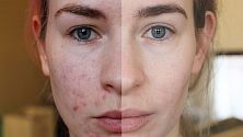 лучшие средства для мезотерапии лица. Смотреть фото лучшие средства для мезотерапии лица. Смотреть картинку лучшие средства для мезотерапии лица. Картинка про лучшие средства для мезотерапии лица. Фото лучшие средства для мезотерапии лица